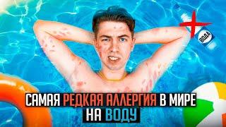 АЛЛЕРГИЯ НА ВОДУ и как я с ней живу?  | НЕ ПЬЮ ВОДУ ?!