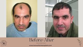 Transes Hair Transplant