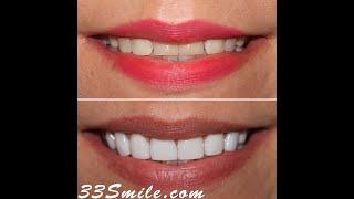 Cosmetic Dentistry Prepless Dental Veneers Before and After.