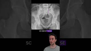 Sacral ala fracture with disruption of the arcuate lines #radiology #medicalstudent #orthopedics