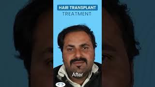 Best Hair Transplant in Delhi at Dr. A's Clinic #shorts #shortsfeed