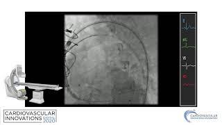 Farhat_Use of Endovascular Snare to Facilitate Delivery of Self Expanding Valve_Structural