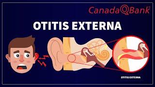 Otitis Externa