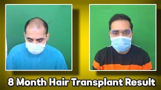 Hair Transplant Result After 8 Month || Dr. Jayanta Bain plastic & cosmetic surgeon