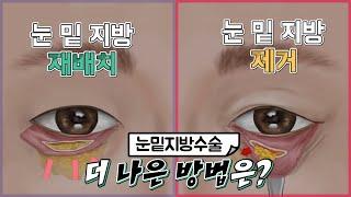 눈밑지방수술 눈밑지방제거 눈밑지방재배치 어떤 방법이 더 우수한가요?