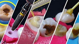 12 BEST dental treatments video compilation in 4K