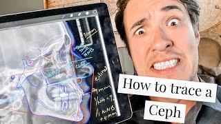 How to trace a Lateral Ceph in orthodontics