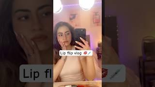 Lip flip botox injections mini vlog and results