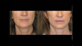 Facelift in Utah -  Dr John Bitner - Layton, Ogden, Logan Utah