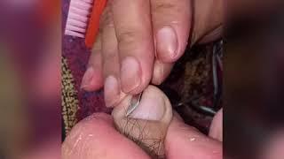 #ALEX CUT SALON  How to remove the ingrown nail