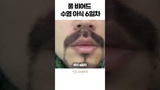 풀비어드 수염 이식 6일차가 진리 #shorts