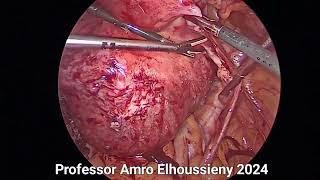 Laparoscopic Hysterectomy  for a Massive Fibroid Uterus By Amro ELhoussieny