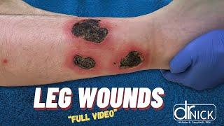 Surgical Debridement of Leg Ulcers on Both Legs | Dr. Nick Campitelli