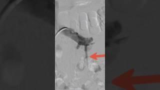 Varicocele embolization live case - Step 4 | Dr. Gaurav Gangwani