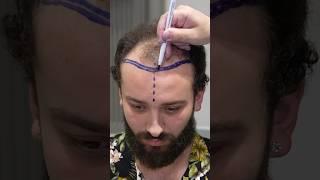 Cosmedica Clinic Hair Transplant in Turkey #shorts #hairtransplant #video