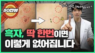 왜 레이저 10번이나 받으세요? 흑자 제거는 1번 만에 치료되는데... 힘들게 병원 왔다 갔다 하지 마세요...