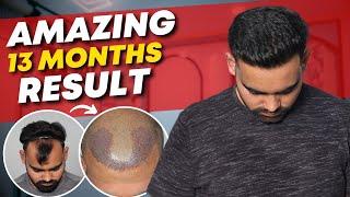 Hair Transplant in Delhi | Best Results & Cost of Hair Transplant in Delhi