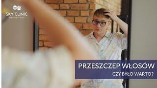 Dlaczego Zdecydowałem się na Przeszczep Włosów? Historia pacjenta Sky Clinic