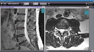 How to Read Your MRI with Onis 2.5 - part 2 of 2 (Advanced Lumbar Spine MRI Anatomy)