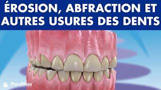 Érosion dentaire, abfraction, attrition et autres USURES DES DENTS ©