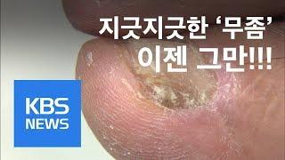 장마철 ‘불청객’ 무좀…치료·예방법은? / KBS뉴스(News)