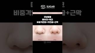 무보형물도 자려한코 가질수있다! #무보형물#자가늑#코성형맛집#슈가성형외과 #코성형꿀팁