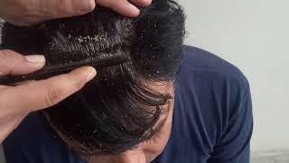 SCRATCHING DANDRUFF 