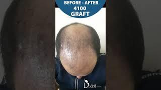 Result of Hair Transplants | Before-After Image | 4100 Graft Implanted #shortsviral