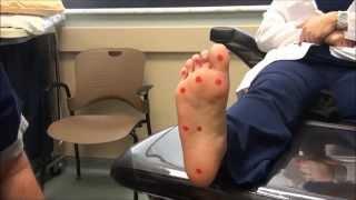 Neurologic Examination of the Foot: 10gm Monofilament Test