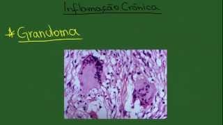 Inflamação Crônica - Resumo - Patologia Geral