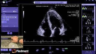 Piedmont Healthcare Left Ventricle Myocardial Strain Workflow on Siemens SC2000