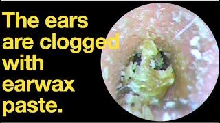 The ears are clogged with earwax paste.|ear wax removal | ear cleaning | ASMR | relaxation | relax