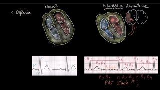 Fibrillation auriculaire - Définition - Impact - Evaluation - Anticoag / HH - FC / Rythme