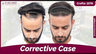 Corrective Hair Transplant Results: Hairline Repair When Hair Transplant Goes Wrong