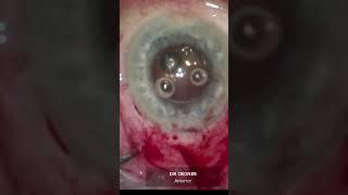 Opacified IOL removal and replacement
