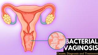 Bacterial vaginosis, Causes, Signs and Symptoms, DIagnosis and Treatment.