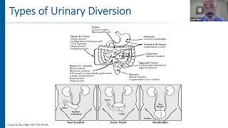 IVUmed VVP: Cystectomy and Bladder Cancer