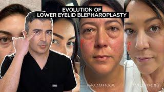 Evolution of Lower Eyelid Blepharoplasty | Dr. Parsa Explains Trifecta Lift