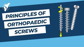 Principles of Orthopaedic Screws | Orthopaedic Academy