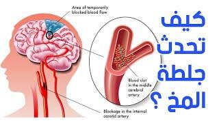 السكتة الدماغية | جلطة المخ