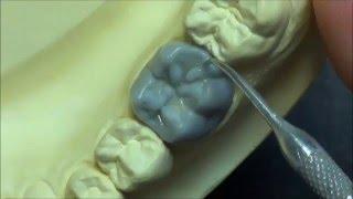 Live wax up - Lower 1st molar wax up (full)