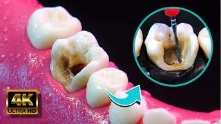 AMAZING restoration of a tooth with deep cavity