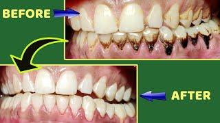 tambaku ke dant kaise saaf karen | teeth tobacco stain removal #shorts