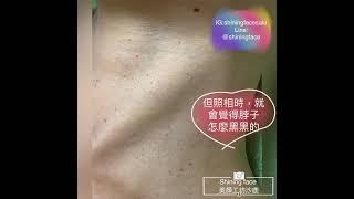 沙鹿無痛清粉刺/惱人的肉芽/垂疣