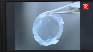 World's first iPS transplant for corneal disease