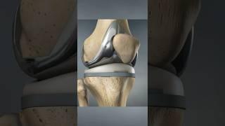 Total knee replacement (3D Animation)