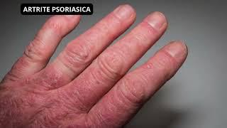 ARTRITE PSORIASICA