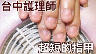 Nail nails, nail bed exposed, Taichung nurse, ultra short nails, nail correction examples