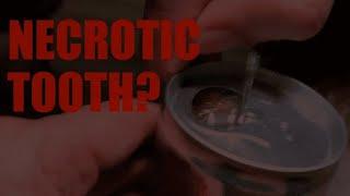 Pain in a Necrotic tooth? | Endodontics | Dr. Agam Bhatnagar | Eeducation.in