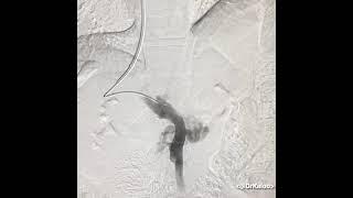 #Anatomy. Portal vein angiography (Portogram) in Cirrhosis (portal hypertension).